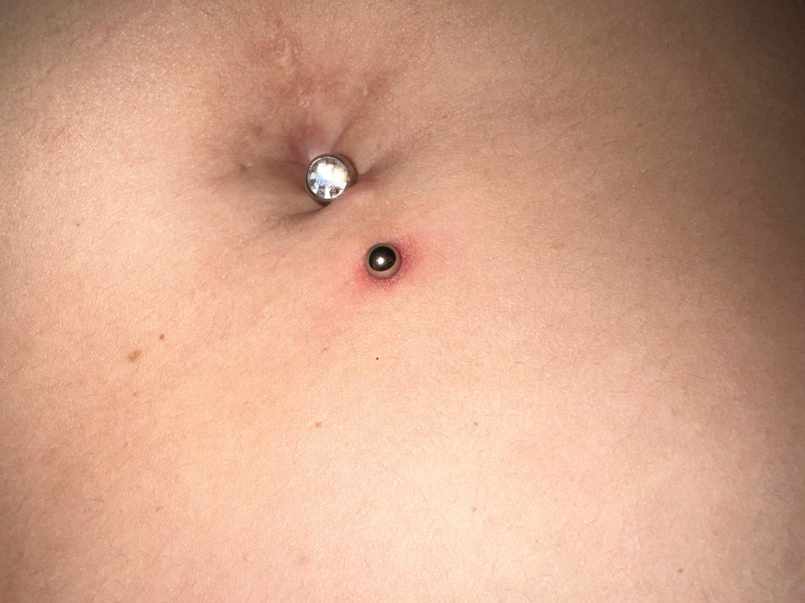 Ich weiß nicht was mit meinem Bauchnabel Piercing los ist? (Entzündung ...