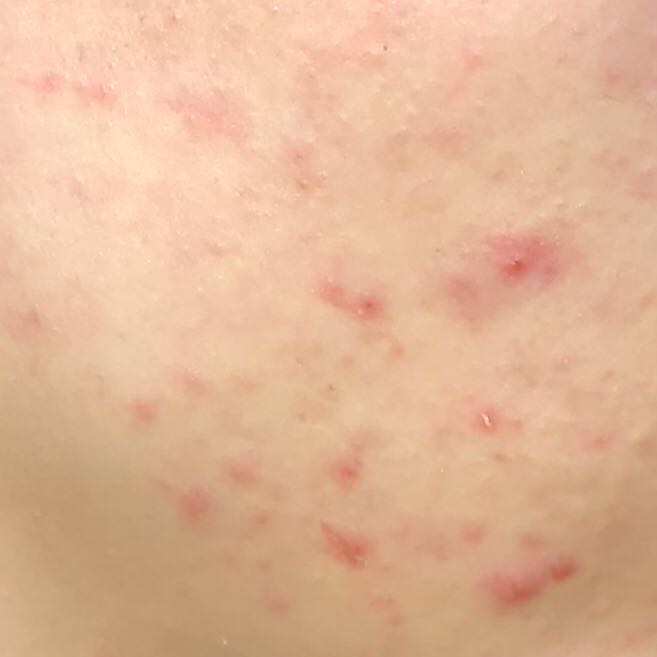 Ich werde wahnsinnig mit diesen Pickeln? (Gesundheit und Medizin, Ernährung, Pickel)