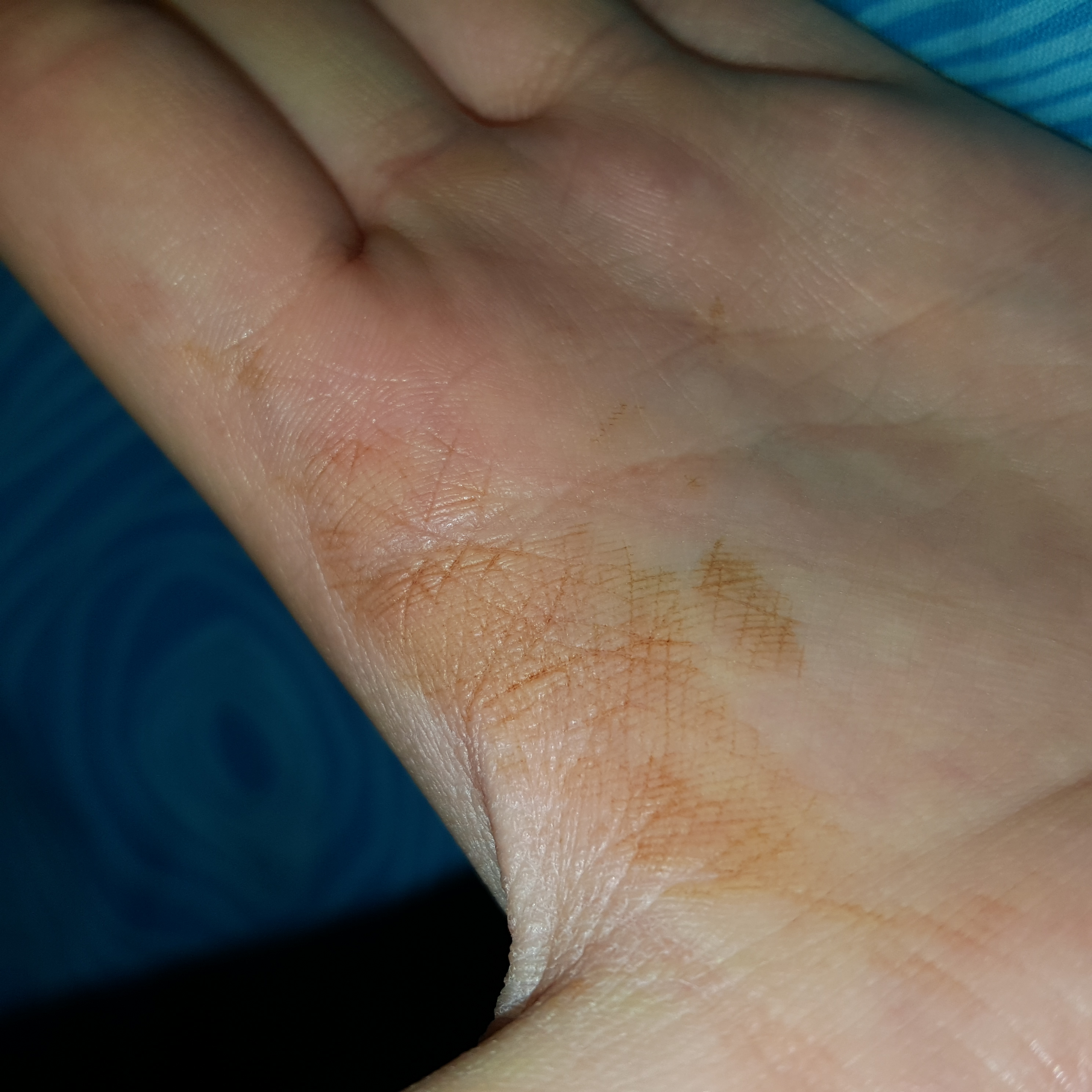 IIch habe gestern beim Duschen diese Flecken bemerkt wo kommt es her? (Hand)