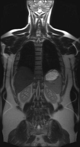 Im MRT ist ein großer weißer Fleck. Ist das Krebs?