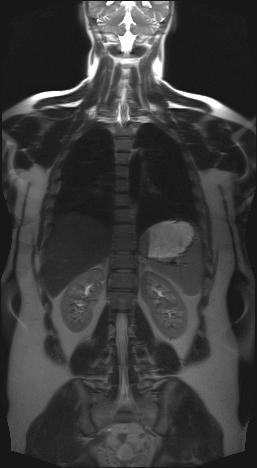 Im MRT ist ein großer weißer Fleck. Ist das Krebs?