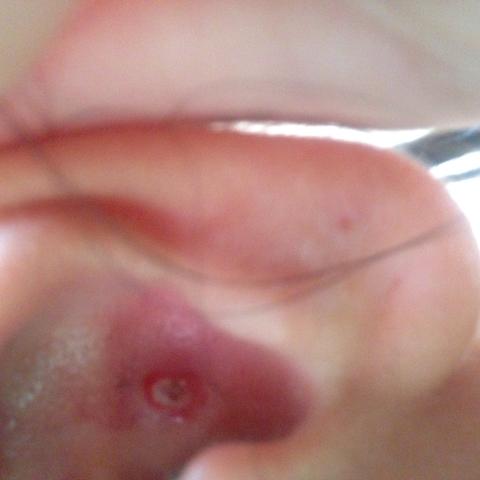 Im Ohr Pickel Schaut Das Bild An