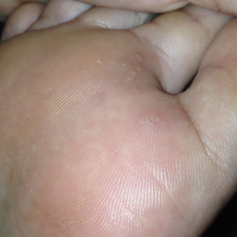 Hornhaut blase unter Hornhaut/Blase am