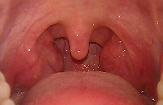 Habe ich immer noch eine Mandelentzündung? (Antibiotika) Habe ich immer noch eine Mandelentzündung? (Antibiotika)