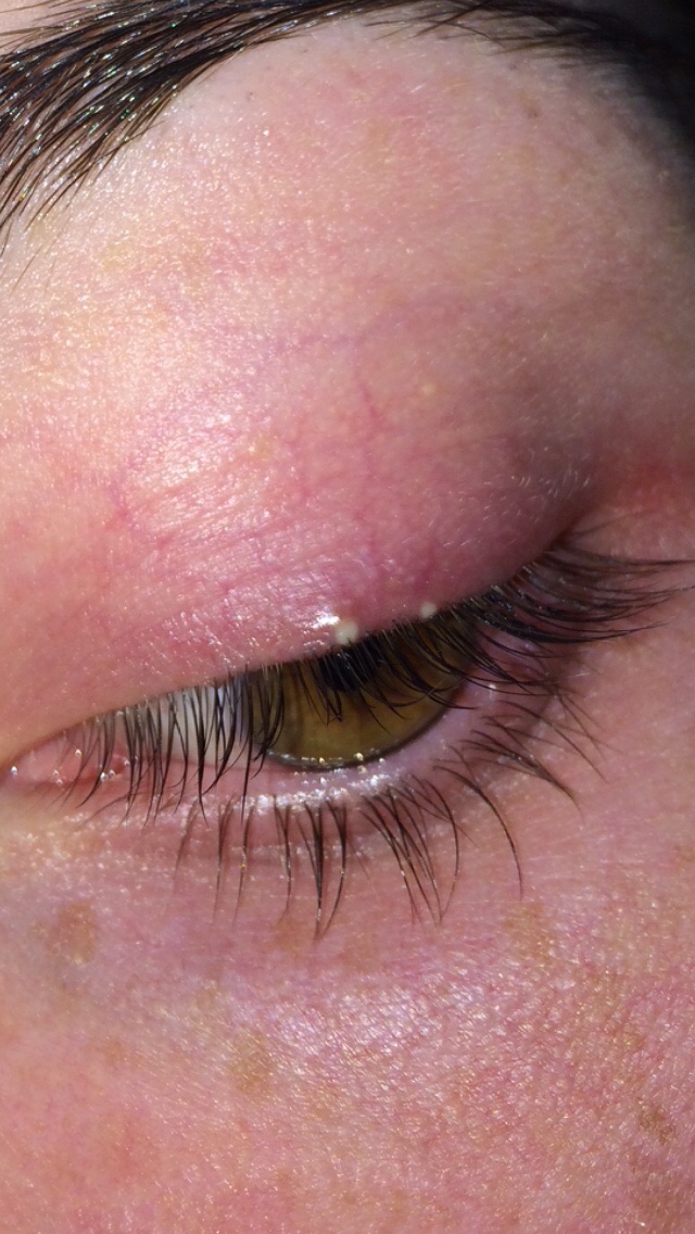 Immer wieder Gerstenkörner/Pickel am Auge? (Gesundheit, Medizin, Arzt)