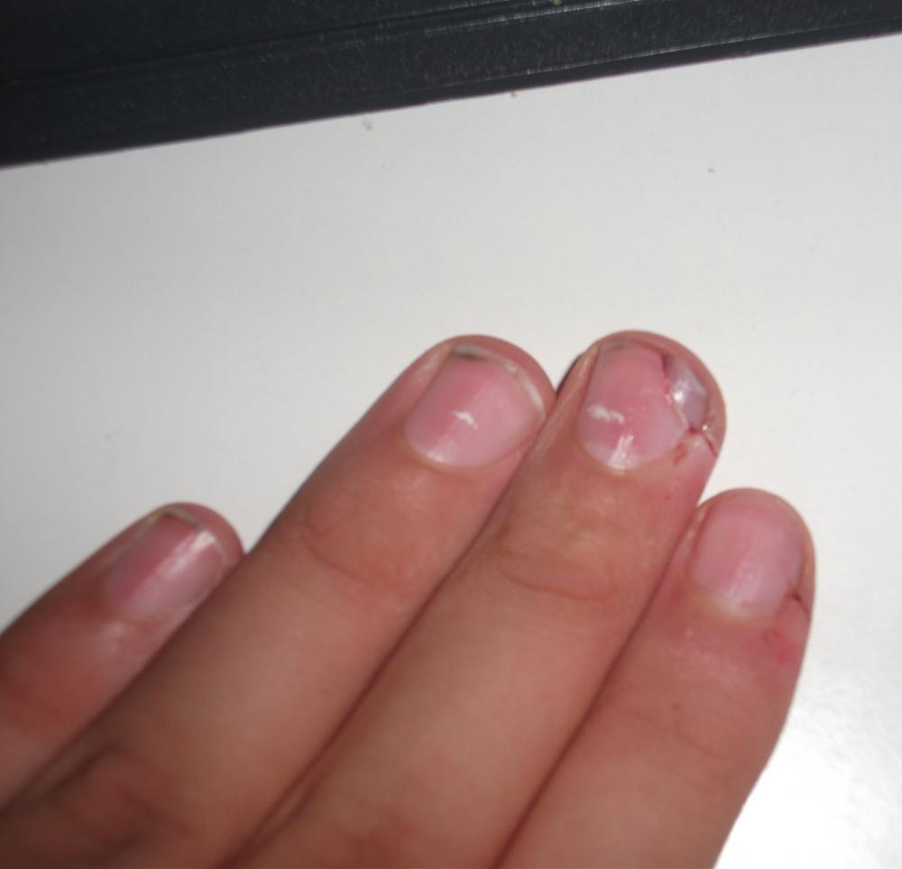 In den Fingernagel rein geschnitten, was tun?! (Verletzung, Nägel, Schnitt)