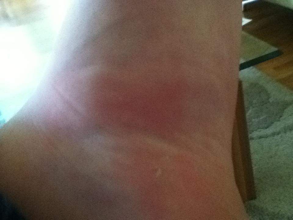 In Dornen getreten. Blutvergiftung? (Gesundheit, Füße, Juckreiz)