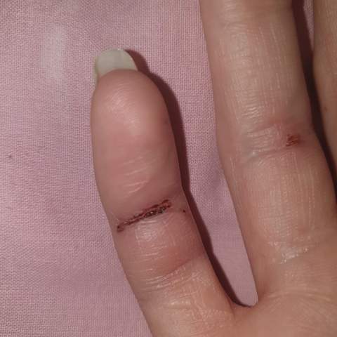 In Finger geschnittten was tun?