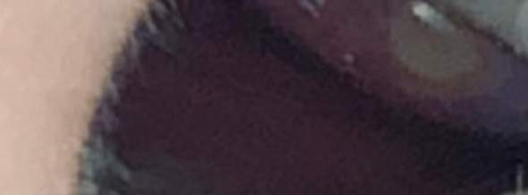 In Nasenhof Gelbe Blase Gesundheit Und Medizin Nase In Nasenhof Gelbe Blase Gesundheit Und Medizin Nase