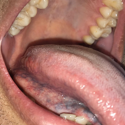 Zungenseite - (Krankheit, Virus, Mund)