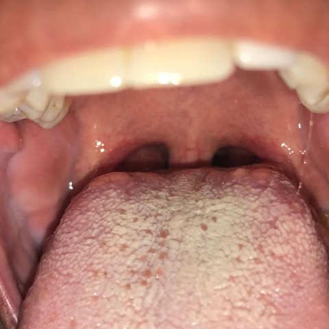 Mandelentzündung Zunge