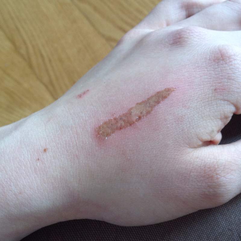 Infektion von Verbrennung (durch Reibung)? (Medizin, Verletzung, Wunde)