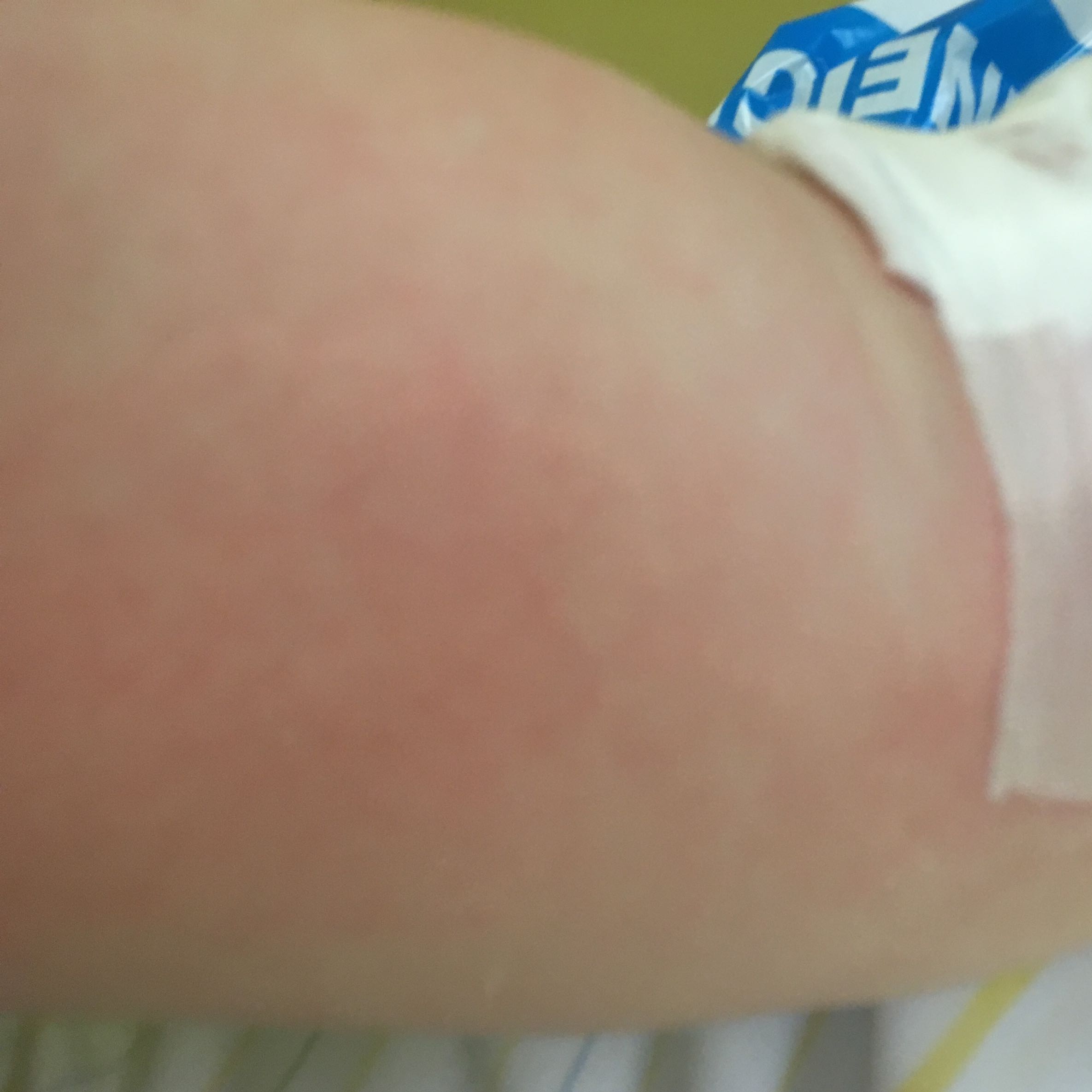 Infusionsnadel Raus Arm Dick Geworden Was Tun Gesundheit Und Medizin Gesundheit Medizin Infusionsnadel Raus Arm Dick Geworden Was Tun Gesundheit Und Medizin Gesundheit Medizin