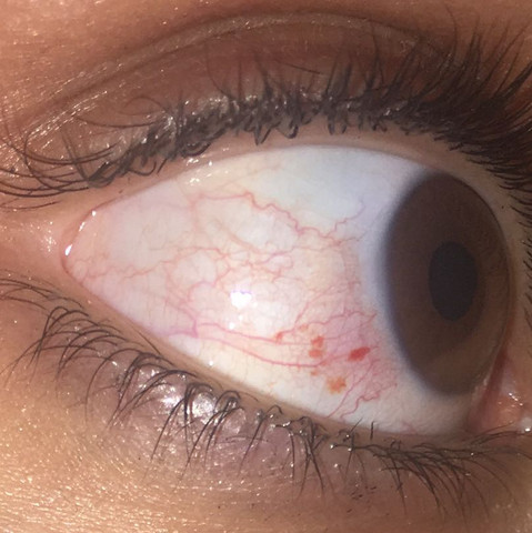 Mein Auge - (Gesundheit und Medizin, Augen, Blut)