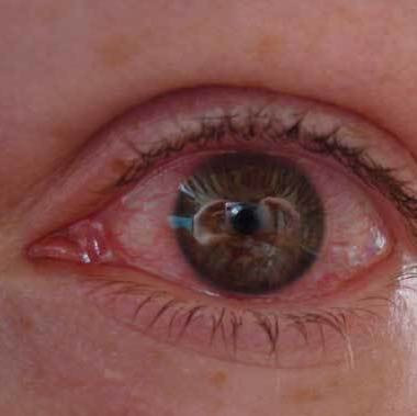 Ins Auge Gespritzt Es Brennt Und Ist Rot Augen Brennen Ins Auge Gespritzt Es Brennt Und Ist Rot Augen Brennen