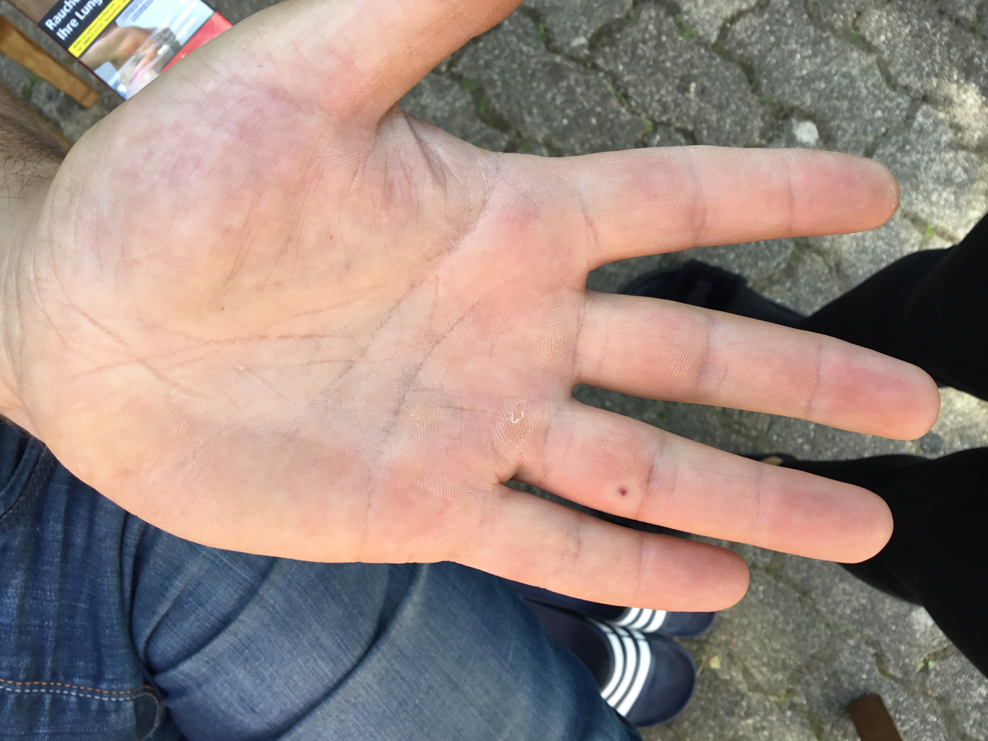 insekt gestochen. finger schwellen an? (Schmerzen, Insekten)