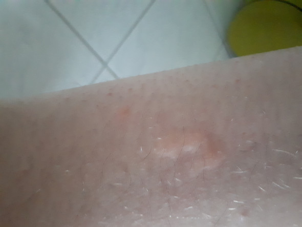 Insekten Stich Im Winter Was Kann Das Sein Arzt Hautarzt Schwellung Insekten Stich Im Winter Was Kann Das Sein Arzt Hautarzt Schwellung