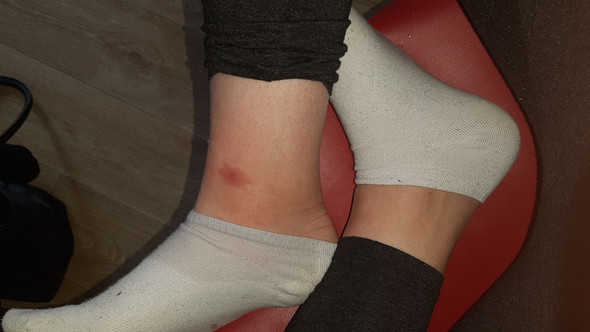 Insektenstich Ganze Wade Geschwollen Gesundheit Und Medizin Verletzung Beine Insektenstich Ganze Wade Geschwollen Gesundheit Und Medizin Verletzung Beine