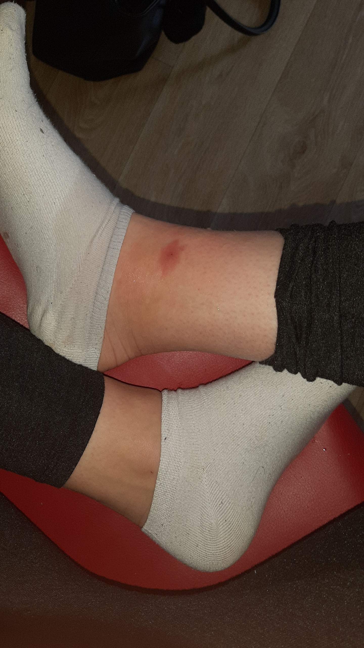 Insektenstich Ganze Wade Geschwollen Gesundheit Und Medizin Verletzung Beine Insektenstich Ganze Wade Geschwollen Gesundheit Und Medizin Verletzung Beine