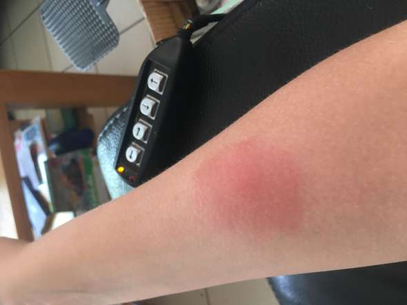 Insektenstich Breitet Sich Aus Normal Insektenstich Breitet Sich Aus Normal