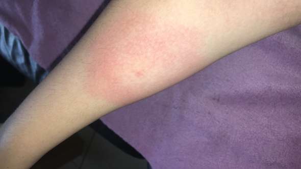 Insektenstich Breitet Sich Aus Normal Insektenstich Breitet Sich Aus Normal