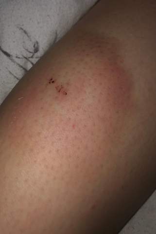 Insektenstich Entzundet Oder Mogliche Blutvergiftung Gesundheit Und Medizin Entzundung Insektenstich Entzundet Oder Mogliche Blutvergiftung Gesundheit Und Medizin Entzundung