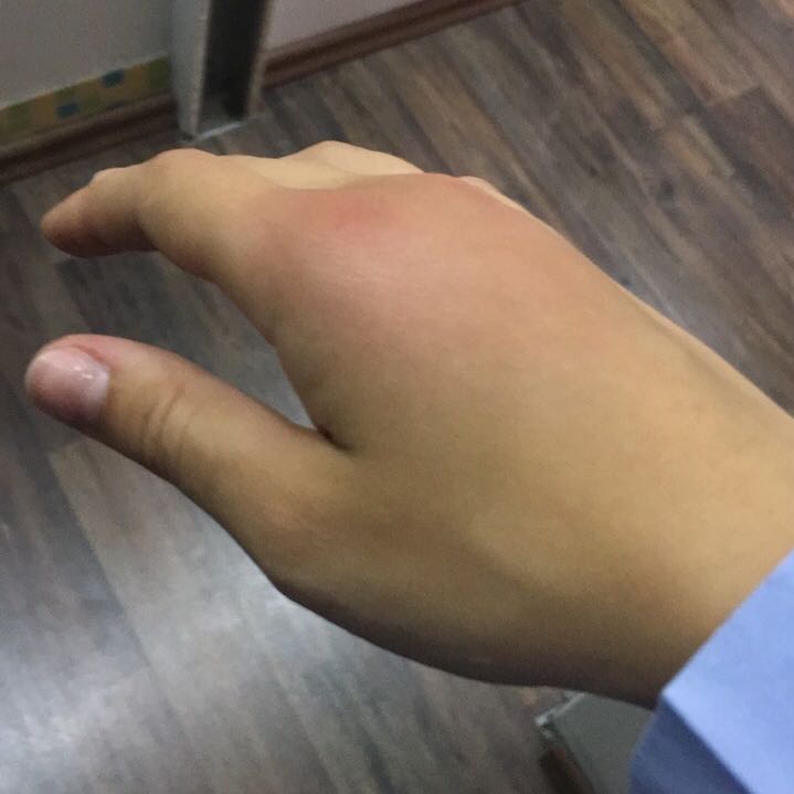 Insektenstich Hand Stark Angeschwollen Insekten Schwellung Stich Insektenstich Hand Stark Angeschwollen Insekten Schwellung Stich
