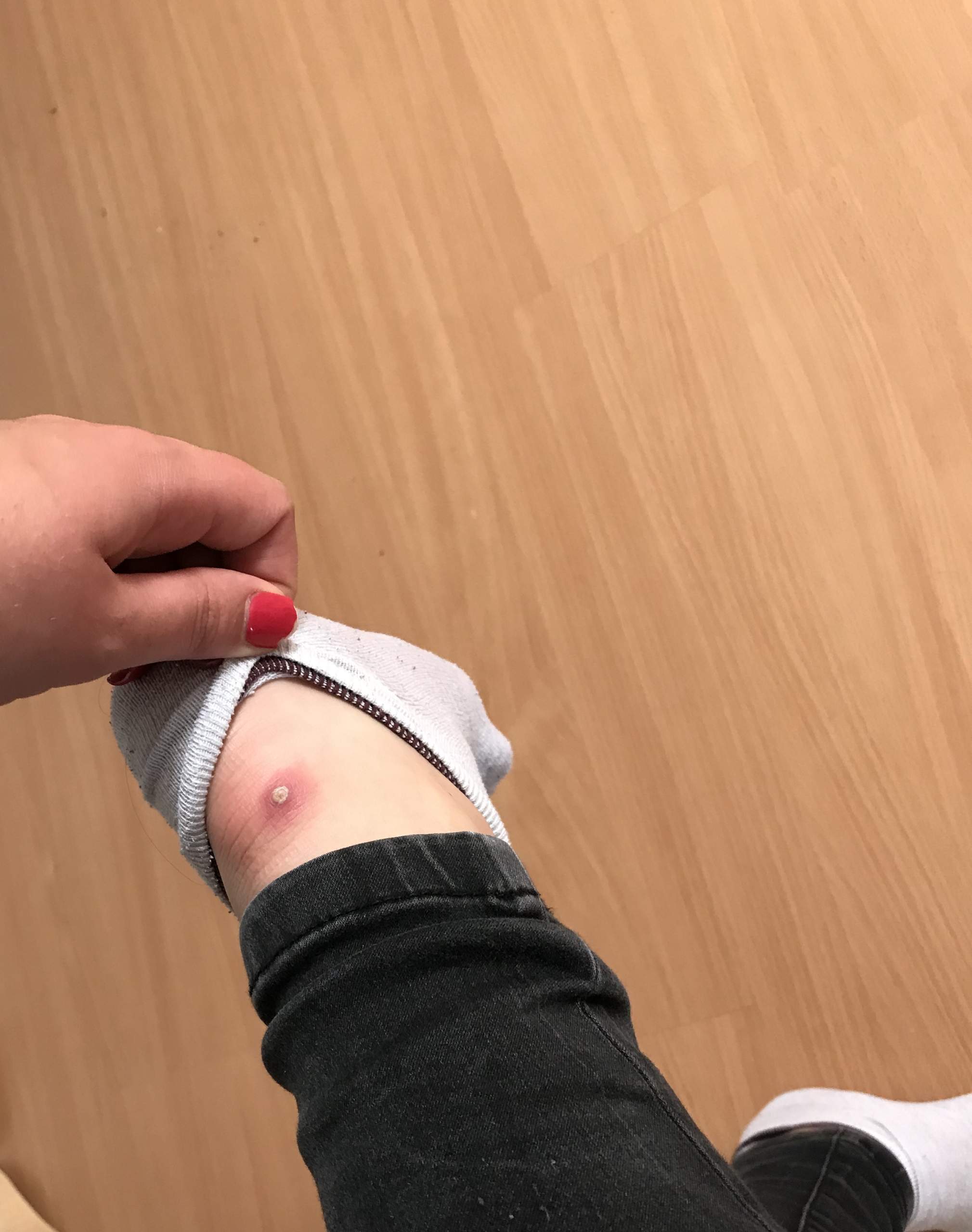 Insektenstich Kriebelmuckenstich Entzundet Gesundheit Und Medizin Entzundung Blutvergiftung Insektenstich Kriebelmuckenstich Entzundet Gesundheit Und Medizin Entzundung Blutvergiftung