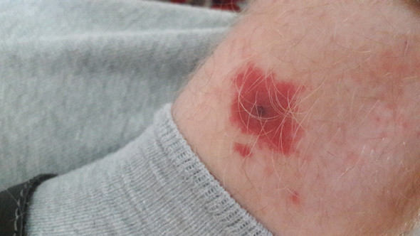 Insektenstich Mit Schwarzem Punkt In Der Mitte Wie Behandeln Krankheit Insektenstich Mit Schwarzem Punkt In Der Mitte Wie Behandeln Krankheit