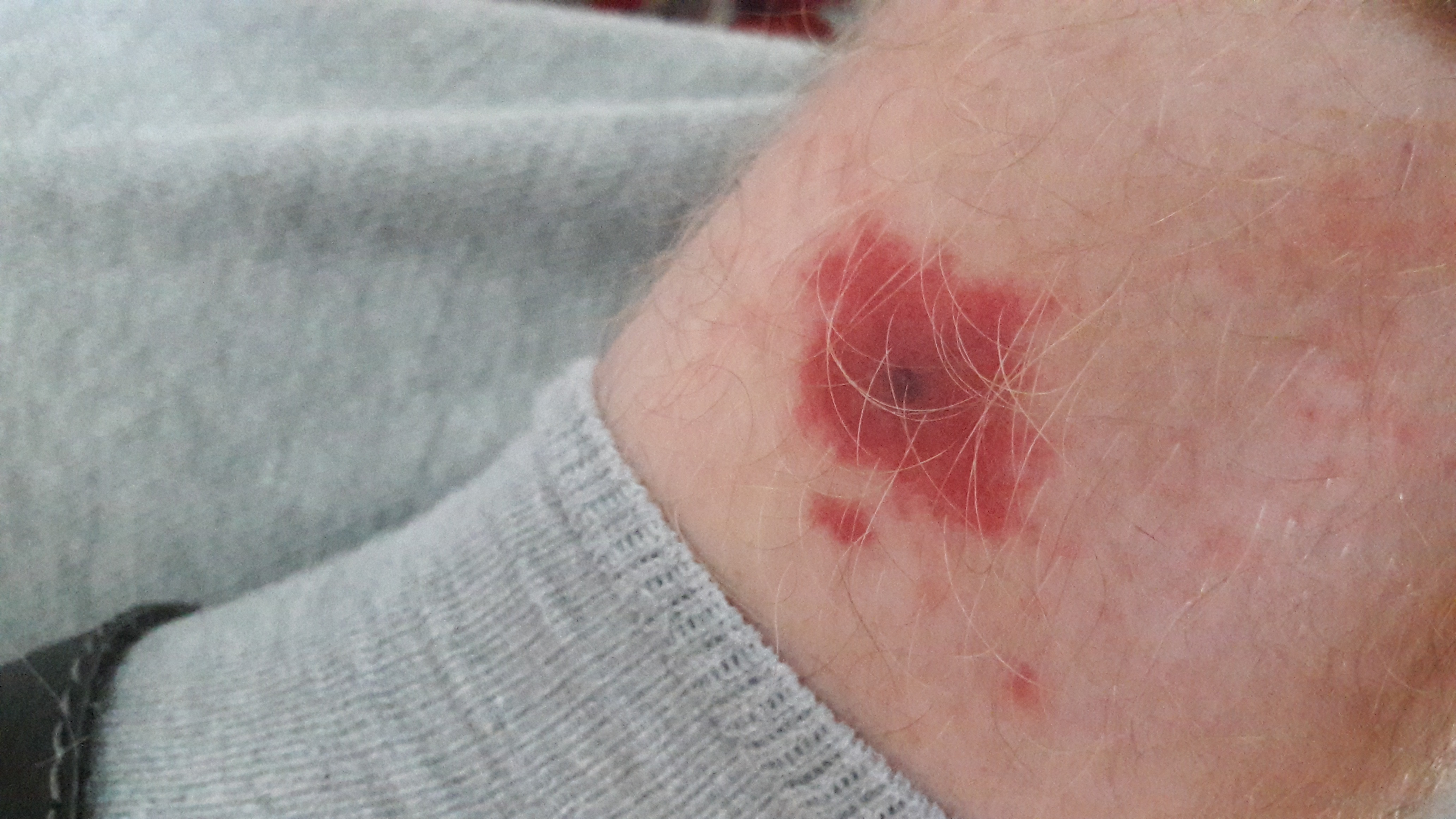 Insektenstich mit schwarzem Punkt in der Mitte wie behandeln Insektenstich mit schwarzem Punkt in der Mitte wie behandeln