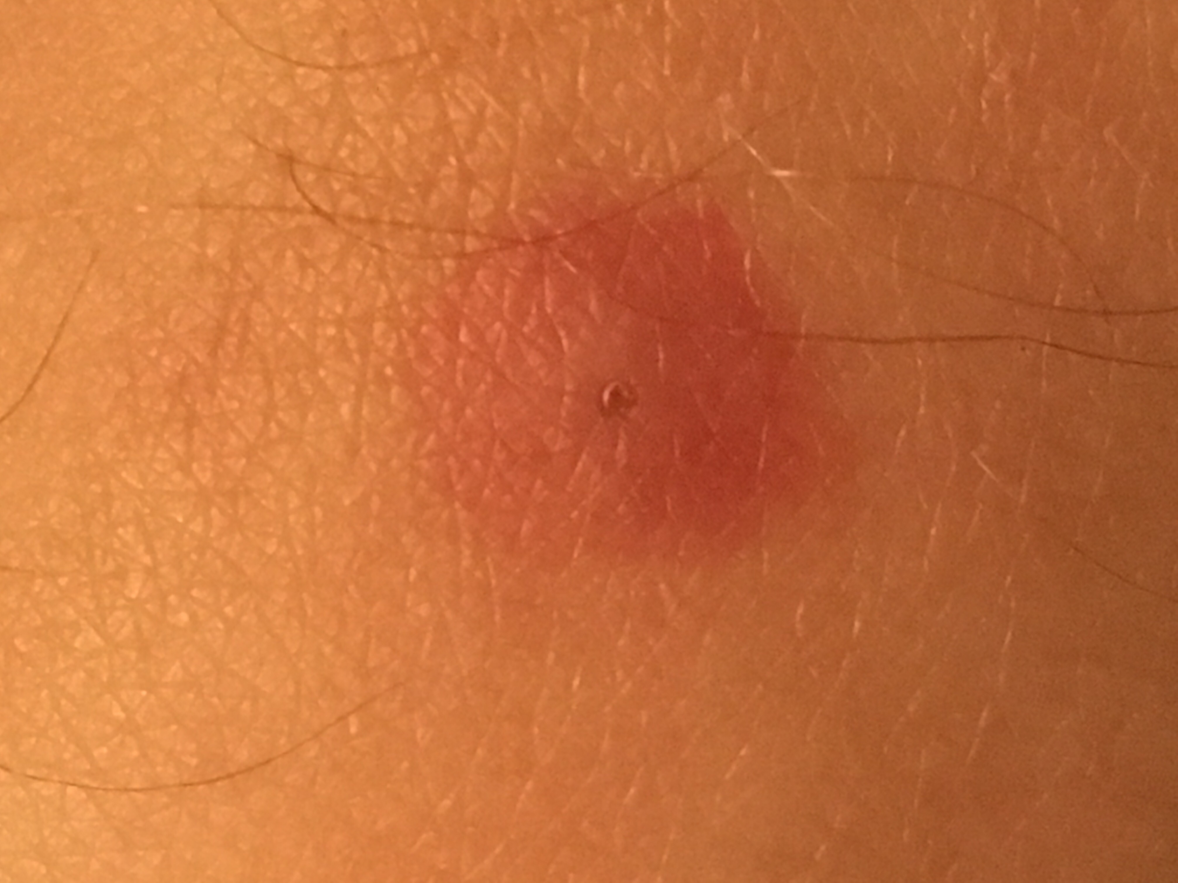 Insektenstich… Wer weiß, von welchem Tier? (Gesundheit und Medizin Insektenstich… Wer weiß, von welchem Tier? (Gesundheit und Medizin