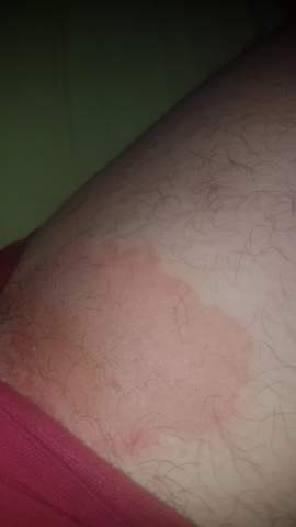 Intimausschlag Welcher Arzt Gesundheit Und Medizin Haut Beine Intimausschlag Welcher Arzt Gesundheit Und Medizin Haut Beine