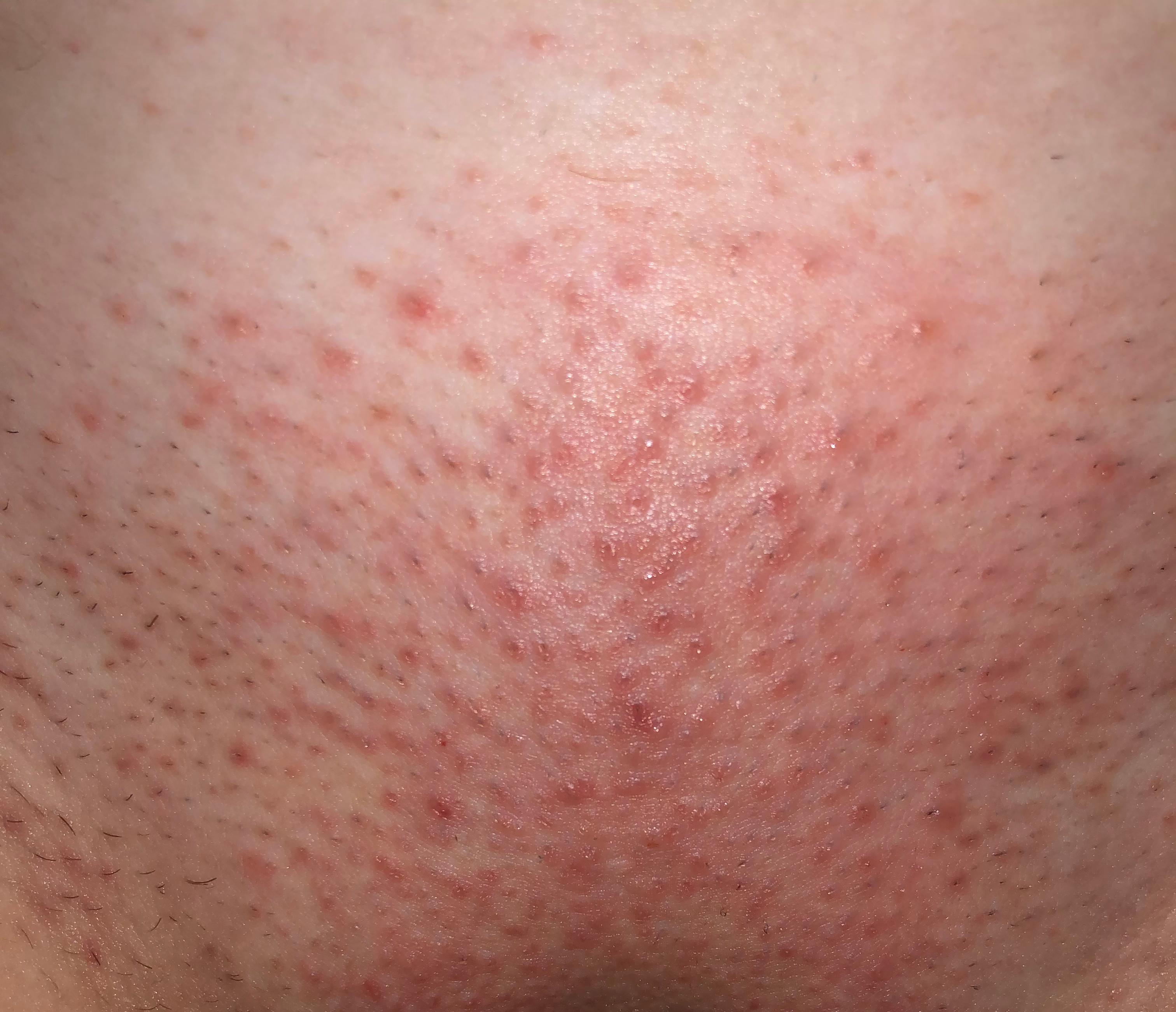 intimrasur extreme hautirritation