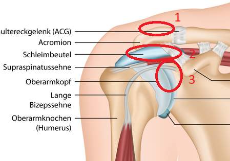 Bizepssehne entzündung Bizepssehnenentzündung ▷