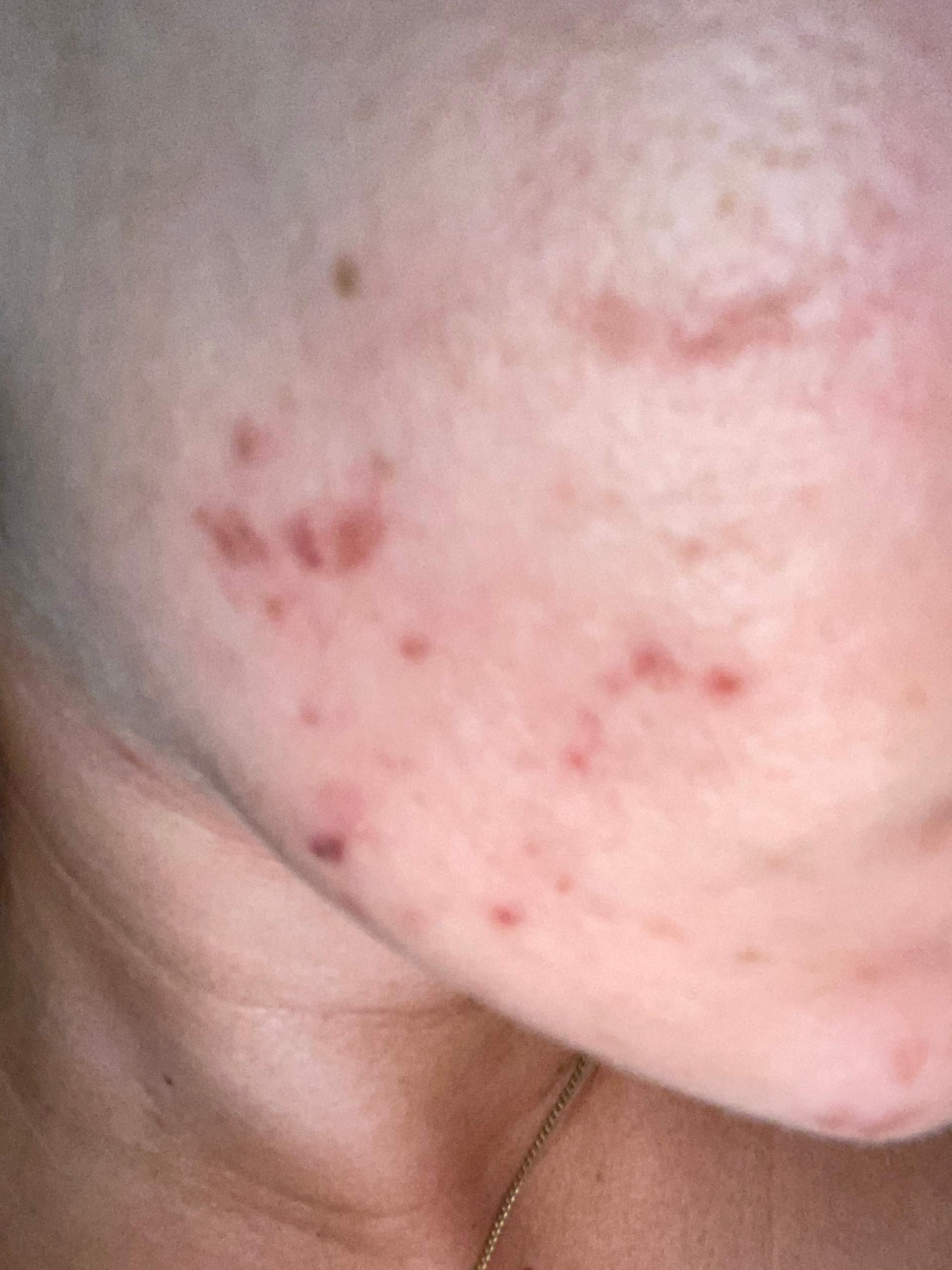 isotretinoin pille