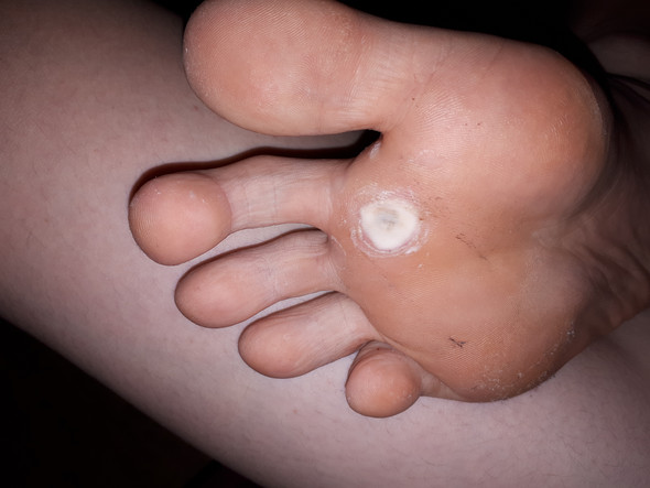 Warzenentfernung: Wie lange dauert es, bis die Warze weg ist? Warzenentfernung: Wie lange dauert es, bis die Warze weg ist?