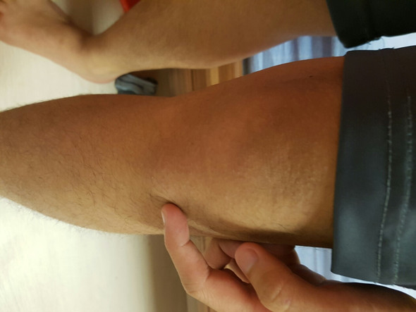 Ist Es Am Knie Normal Beule Ist Es Am Knie Normal Beule