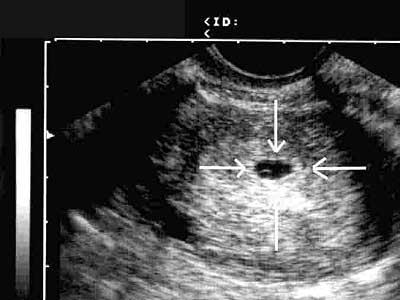 Ultraschallbild 6. SSW - (Gesundheit, Schwangerschaft, schwanger)