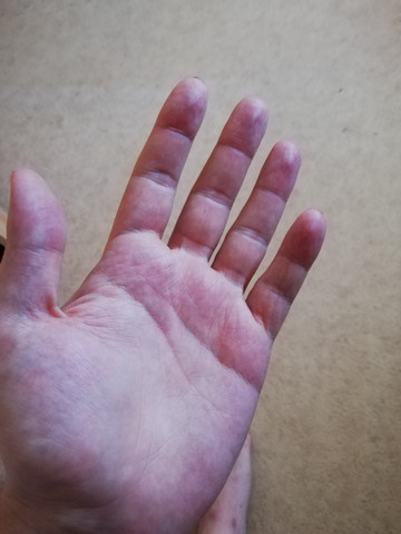 Ist Bei Euch Der Kleine Finger Auch Leicht Eingeknickt Gesundheit Und Medizin Medizin Ist Bei Euch Der Kleine Finger Auch Leicht Eingeknickt Gesundheit Und Medizin Medizin