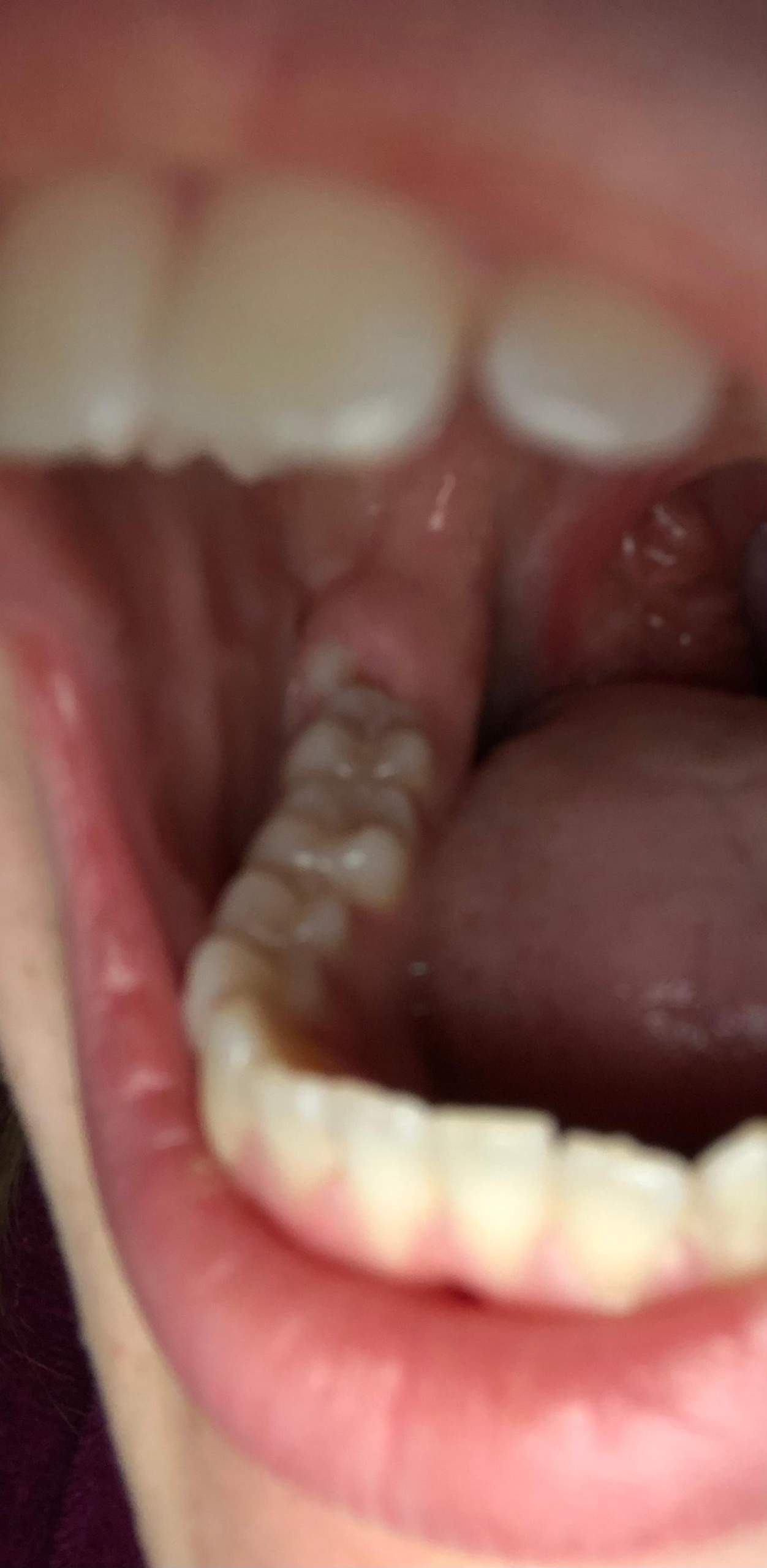 Ist Bei Meinem Weisheitszahn Alles Ok Gesundheit Und Medizin Zahne Weisheitszahne Ist Bei Meinem Weisheitszahn Alles Ok Gesundheit Und Medizin Zahne Weisheitszahne