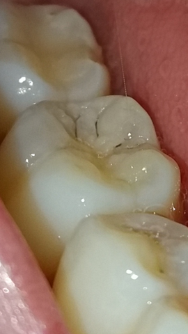 Ist Da Karies Oder Eine Verfarbung Zahne Zahnarzt Kariesbehandlung