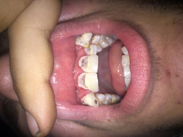 Ist Da Noch Was Zu Retten Habe Angst Dass Sie Gezogen Werden Mussen Zahne Fullung Ist Da Noch Was Zu Retten Habe Angst Dass Sie Gezogen Werden Mussen Zahne Fullung