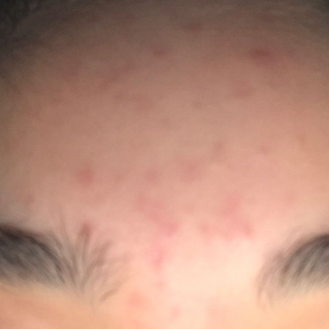 Ist Das Akne Was Kann Ich Dagegen Tuen Pickel Pickelmale