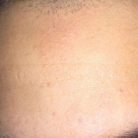....... - (Gesundheit und Medizin, Beauty, Pickel)