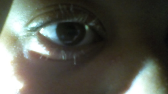 Das Rote am Auge (nicht gut zu erkennen) - (Augen, Verletzung)