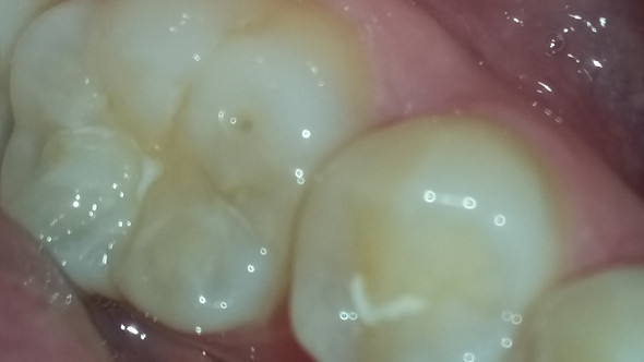 Zahn2 - (Zähne, Zahnarzt, Zahnmedizin)