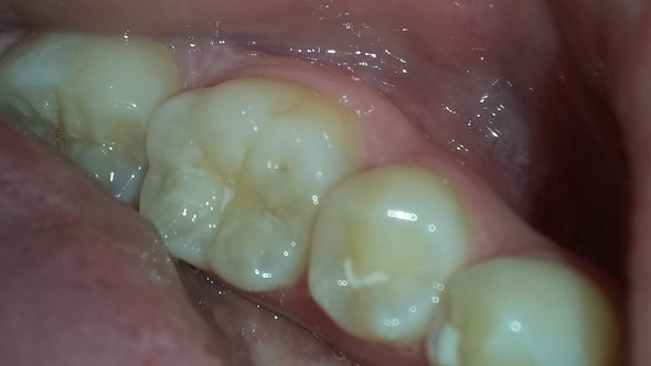 Zahn 3 - (Zähne, Zahnarzt, Zahnmedizin)