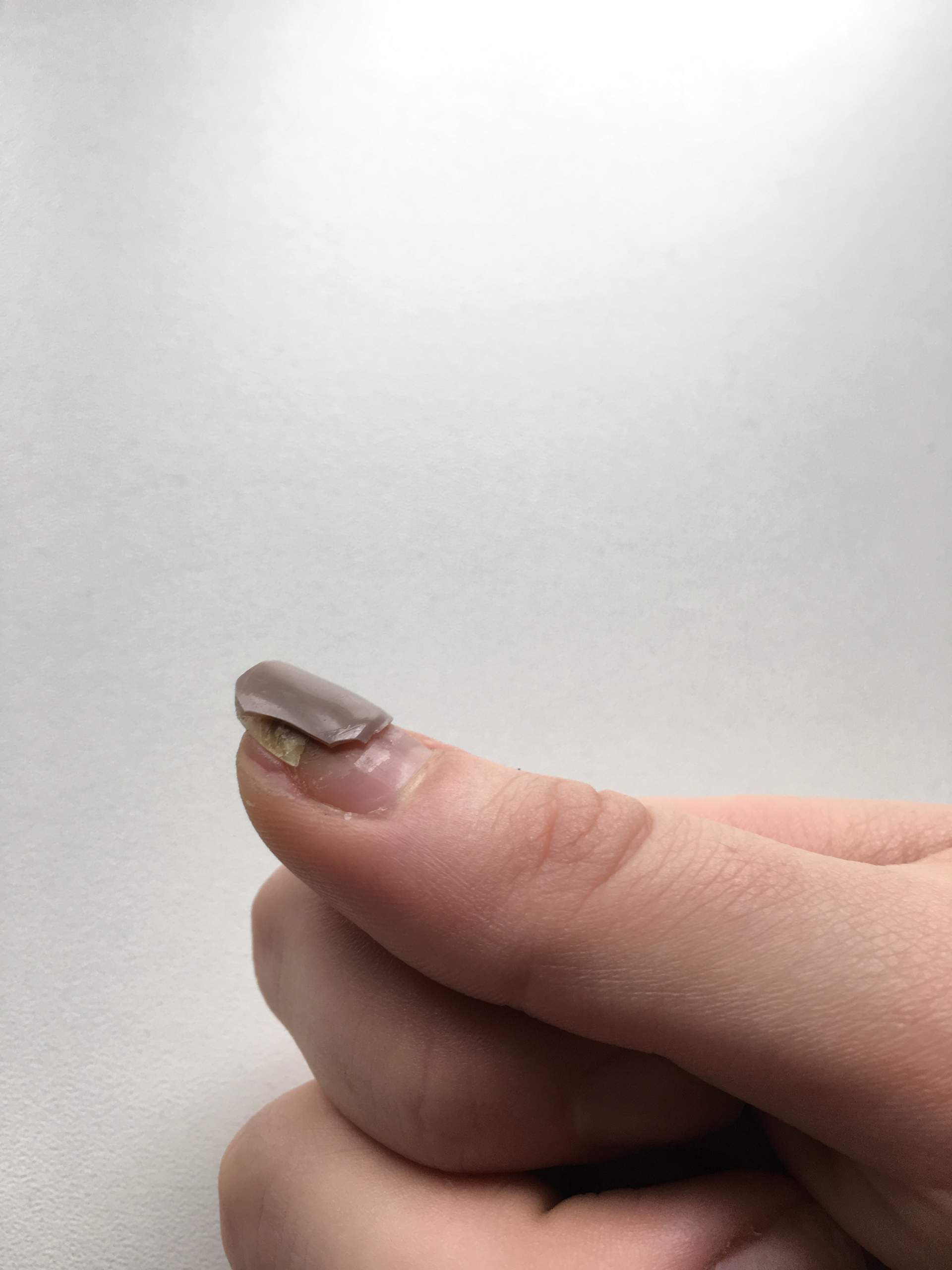 Ist das auf meinem Fingernagel Nagelpilz? (Gesundheit, Nägel)
