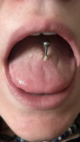Ist das beim Zungenpiercing normal?