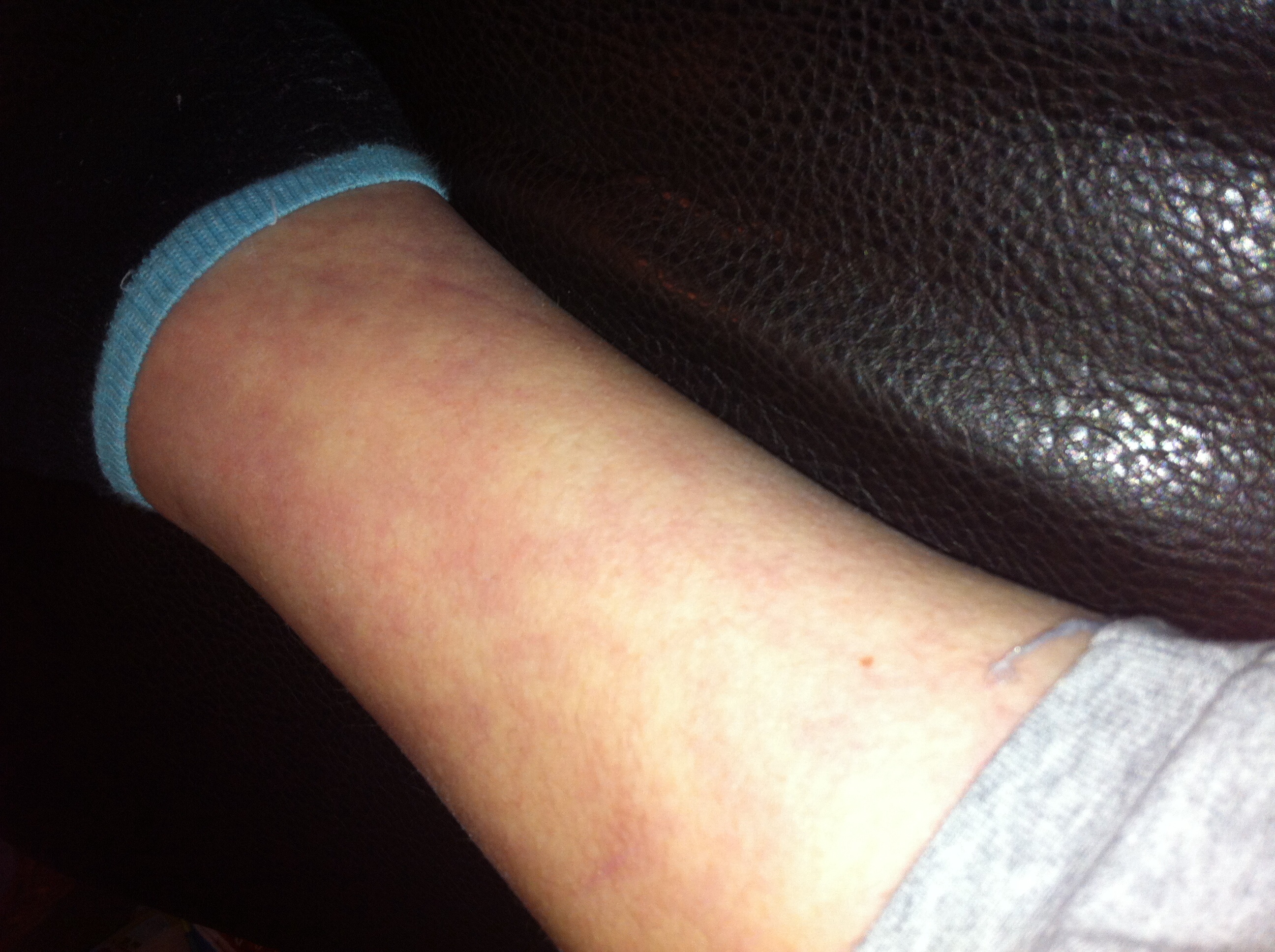 Ist das das erste Raucherbein Stadium? (Zigaretten)